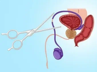 Comparing Vasectomy Options in Auckland: Private vs Public Clinics